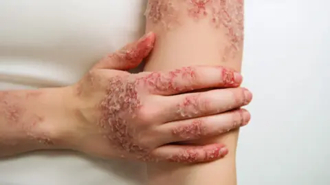 psoriasis